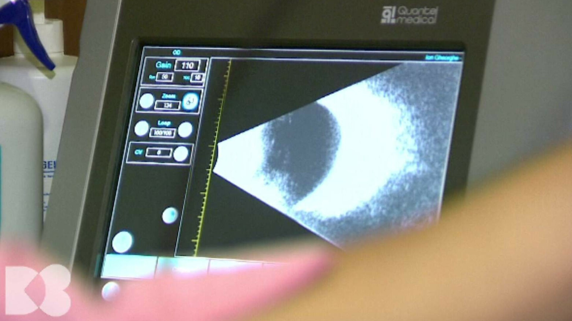 Legătura între diabet, glicemia crescută, colapsul rinichilor și vindecarea anevoioasă a rănilor