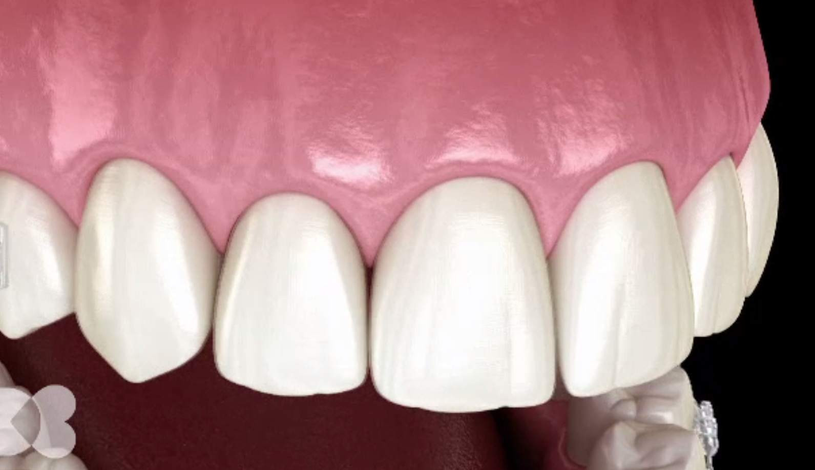 Cum funcționează aparatele dentare pentru adulți și la ce trebuie să fim atenți