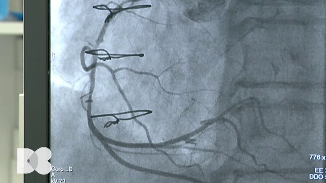Doctor de bine | Ce este atero-scleroza și cum se tratează