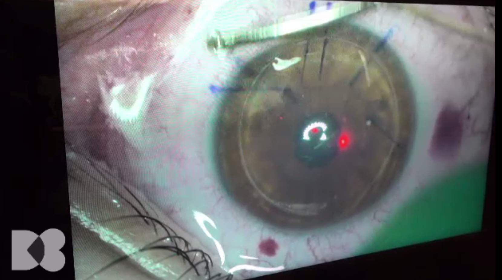 Cum se poate corecta miopia și când nu se recomandă operația cu laser