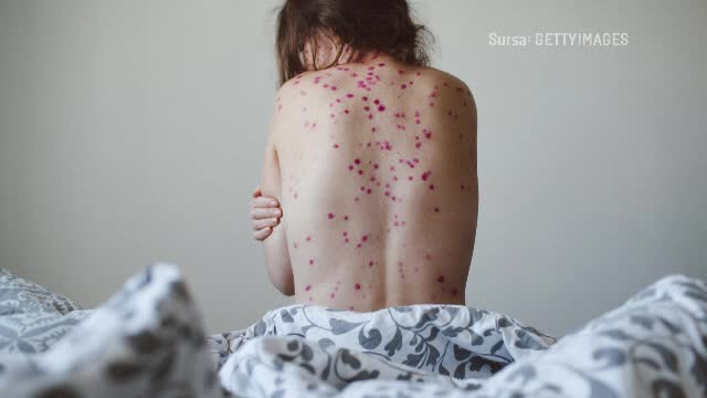 Un prim caz de variola maimuţei, depistat în Cehia