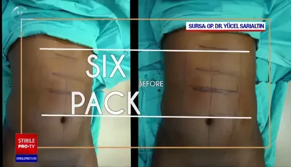 Tot mai mulți bărbați români își fac operații estetice pentru a-și “sculpta” grăsimea de pe burtă în faimoasele ‘pătrățele”