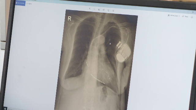 Premieră în România. Doi pacienți au primit câte un stimulator cardiac fără fir