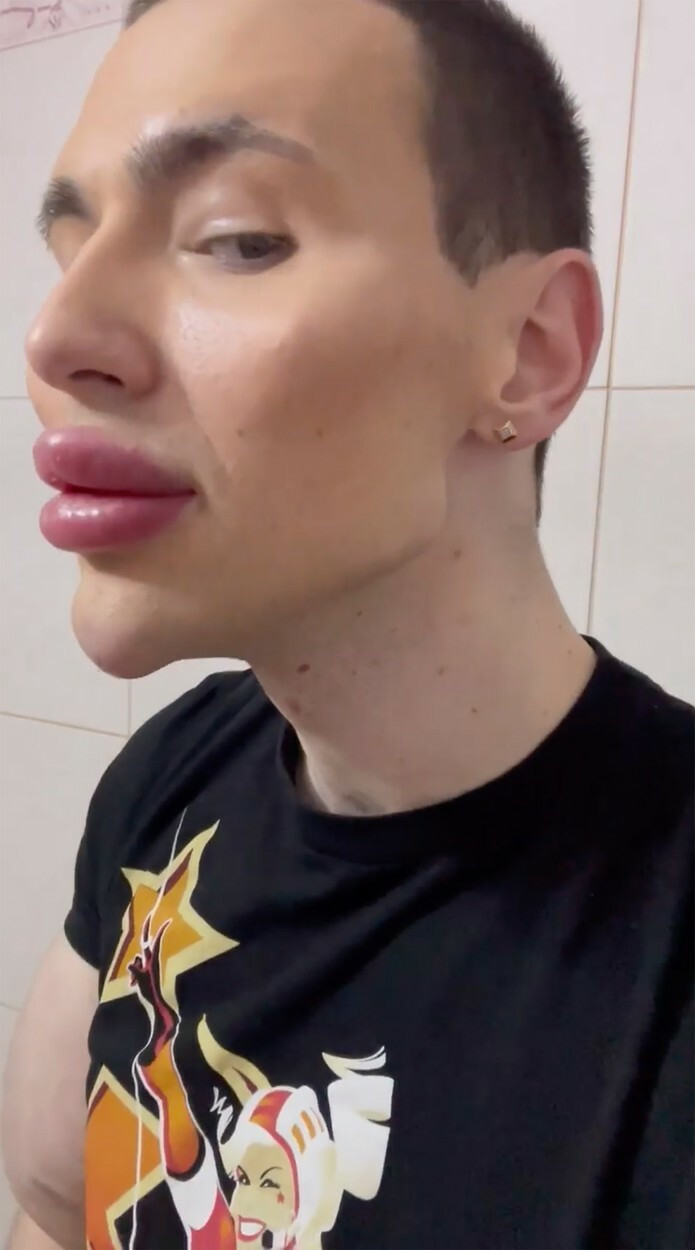 „Popeye”, rusul care și-a injectat ulei în bicepși, și-a făcut operații estetice. Vrea să arate „ca un extraterestru”. FOTO