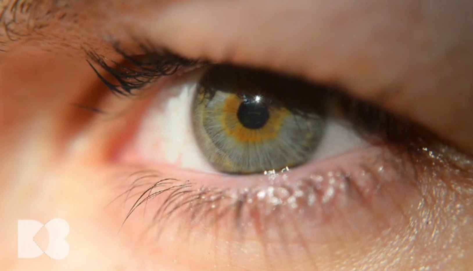 Ce înseamna cataracta și cum se rezolvă cu Femto laserul. E considerată cea mai sigură intervenție