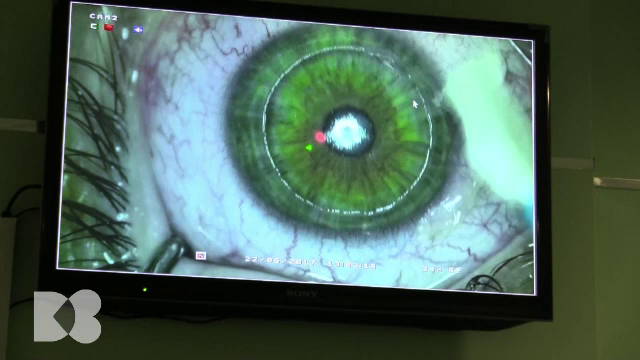 Cataracta, boala oftalmologică cel mai des întâlnită, tratată cu tehnica femto-laser. Cum funcționează