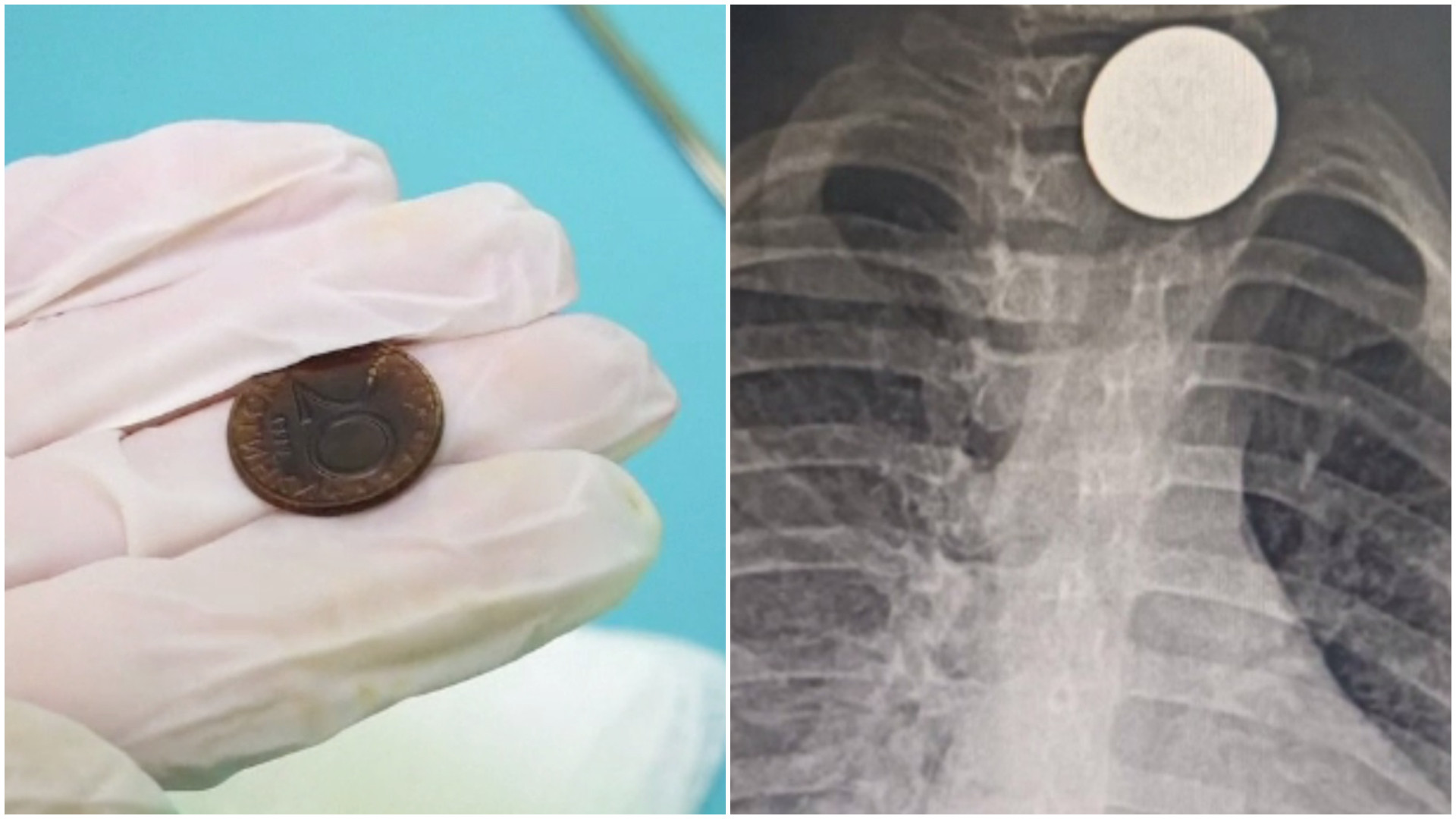 La un pas de tragedie. O fetiță din Bulgaria a stat cu o monedă în corp mai bine o lună și jumătate