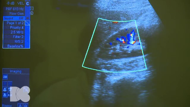 Obiceiul care previne pietrele la rinichi. Infecțiile renale rezultate pot ajunge în sânge