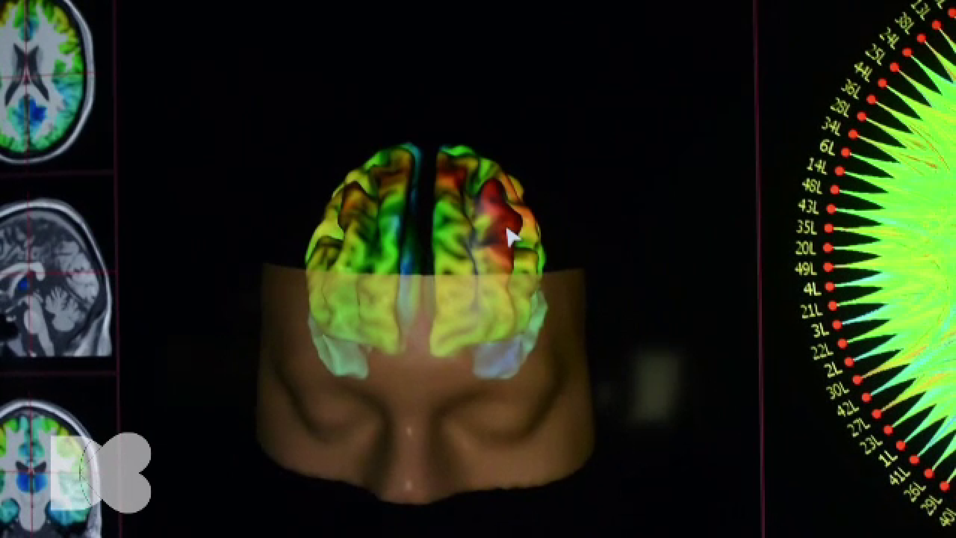 Ce este epilepsia și cum se manifestă