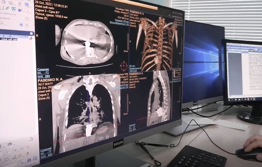 Unui soldat rus i-a fost scoasă din piept o bombă ucraineană neexplodată