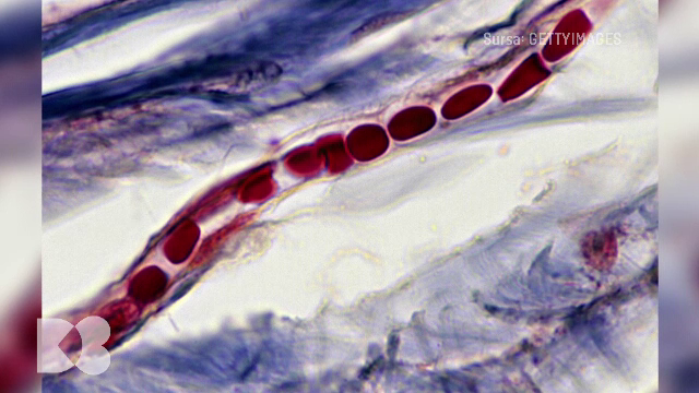 Atero-scleroză și principalul factor care o produce. Explicațiile medicilor