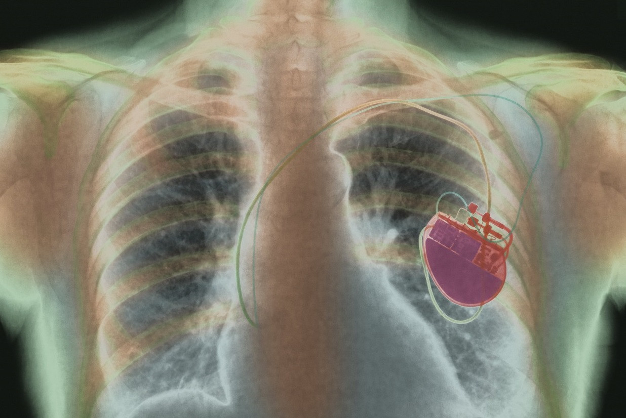 Mărturia unei paciente căreia i s-a implantat stimulator cardiac de la un mort: Intervenția a durat mult, au fost complicații