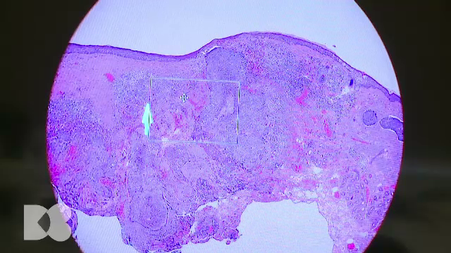 Cel mai frecvent tip de cancer. 20% din populație va face un carcinom