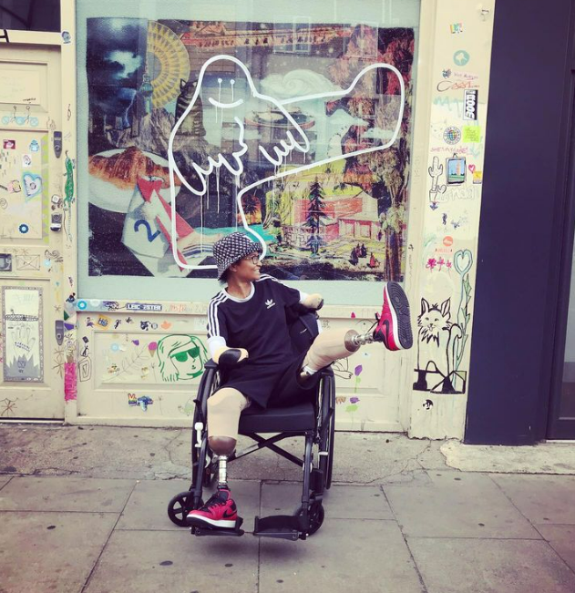 Dansatoarea fără mâini și picioare. Povestea unei femei care și-a ambutat membrele din cauza unei mușcături de țânțar