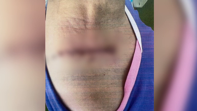 O femeie din Craiova s-a ales cu o arsură de gradul III în timp ce făcea un RMN. A fost operată de urgență