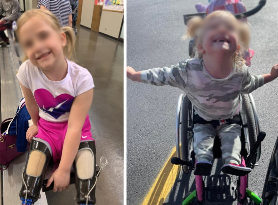 „Este un miracol”. O fetiță care s-a născut cu o coadă de sirenă face primii pași. Medicii nu îi dădeau nicio șansă