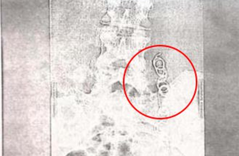 „Nu mi-a venit să cred”. Ce au găsit medicii în stomacul unei femei care avea dureri de burtă de 11 ani