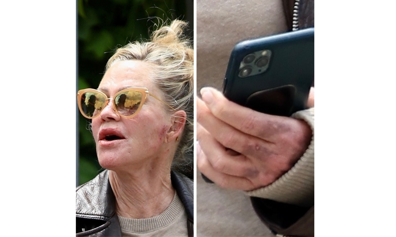 Actrița Melanie Griffith, apariție îngrijorătoare. A fost văzută cu răni pe față și vânătăi pe mâini | GALERIE FOTO