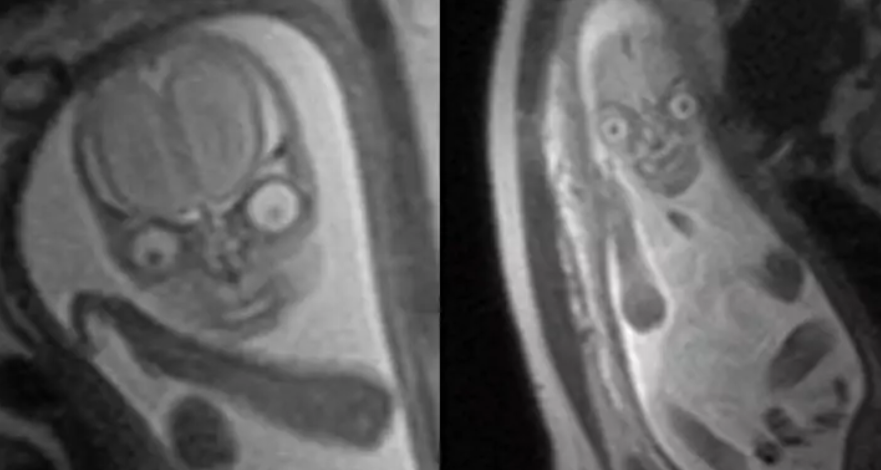 O femeie s-a dus să își facă un RMN, dar a rămas îngrozită când a văzut rezultatul. ”Arată ca un copil demon”