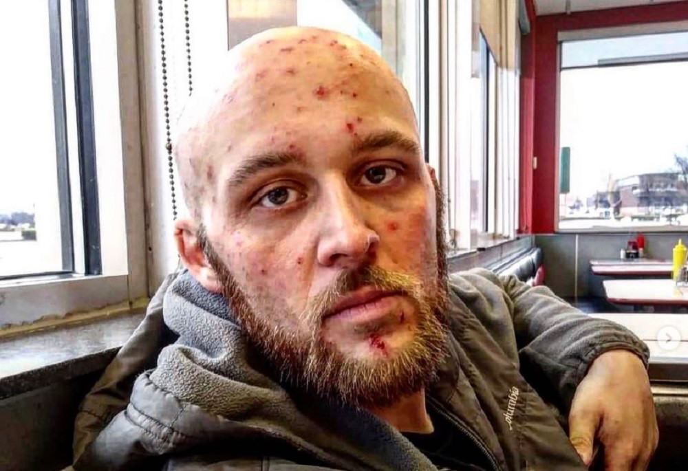 A câștigat o luptă cruntă. Transformare uluitoare a unui tânăr care s-a umplut de bube din cauza drogurilor | GALERIE FOTO