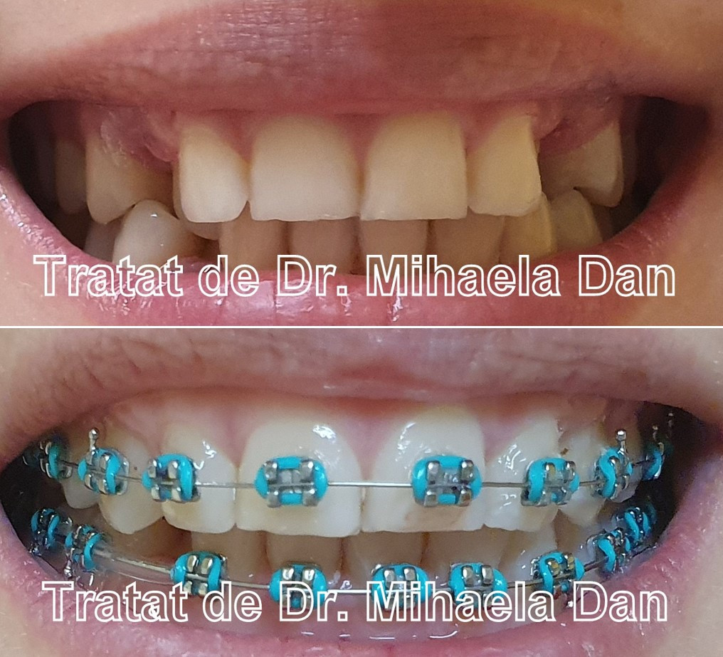 (P) Aparatul dentar și succesul în carieră