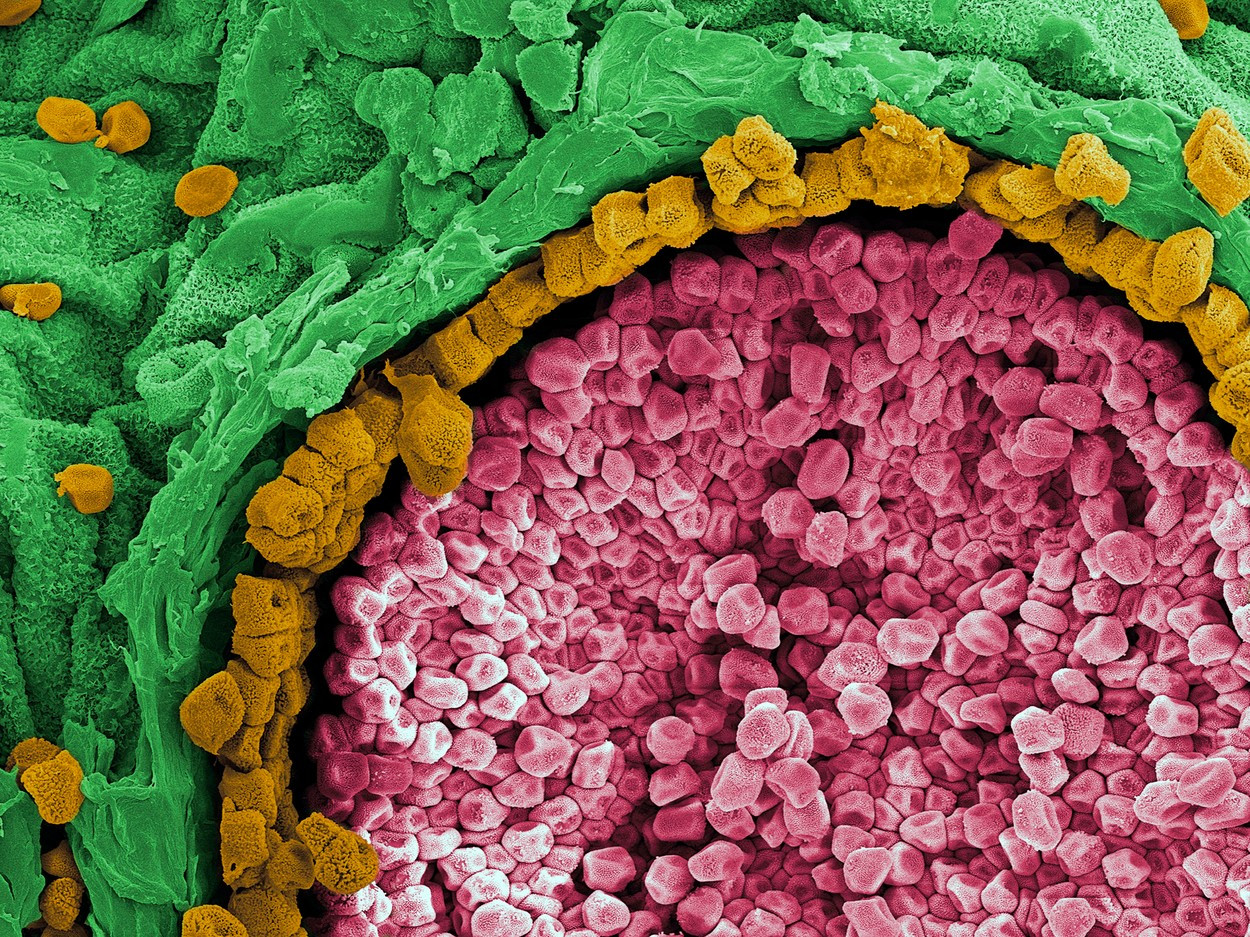 Avertismentul medicilor: „Lumea nu este pregătită pentru asta”. Două femei s-au infectat cu o boală fungică contagioasă