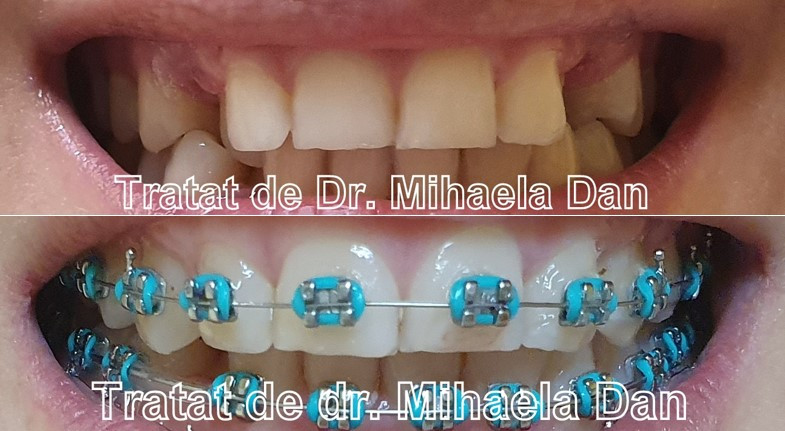 aparat dentar