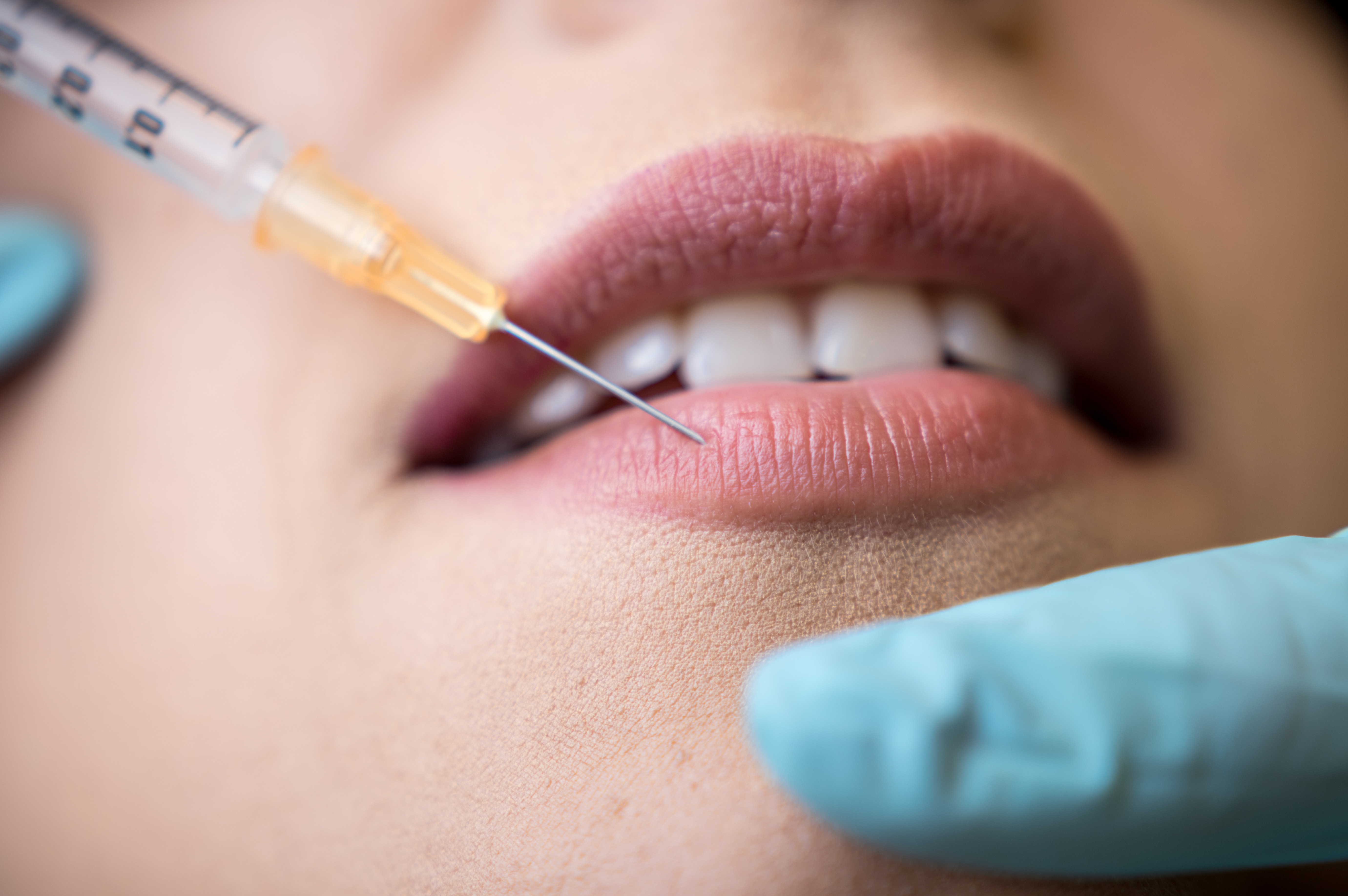 O tânără din București, medic fals, a fost reținută după ce ar fi injectat acid hialuronic în buze mai multor femei