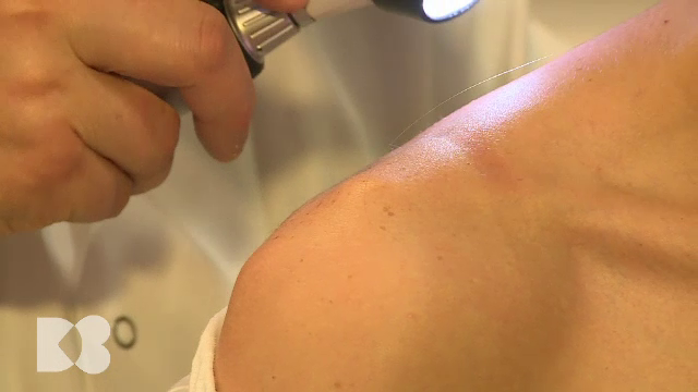 „Nu zgârietura produce cancer, cancerul era!”. De ce trebuie ca alunițele de pe corp să fie văzute de medic de două ori pe an