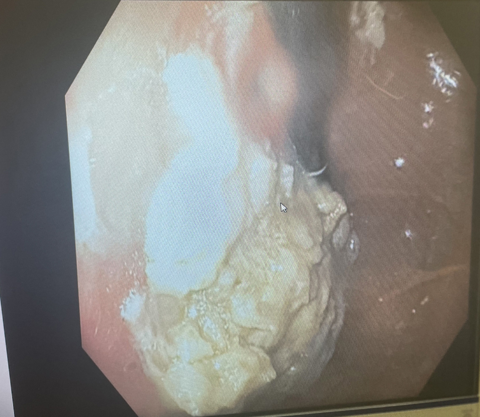 Ce au descoperit medicii când i-au făcut o radiografie unui copil de cinci ani. Ce era de fapt ghemul uriaș din stomacul său
