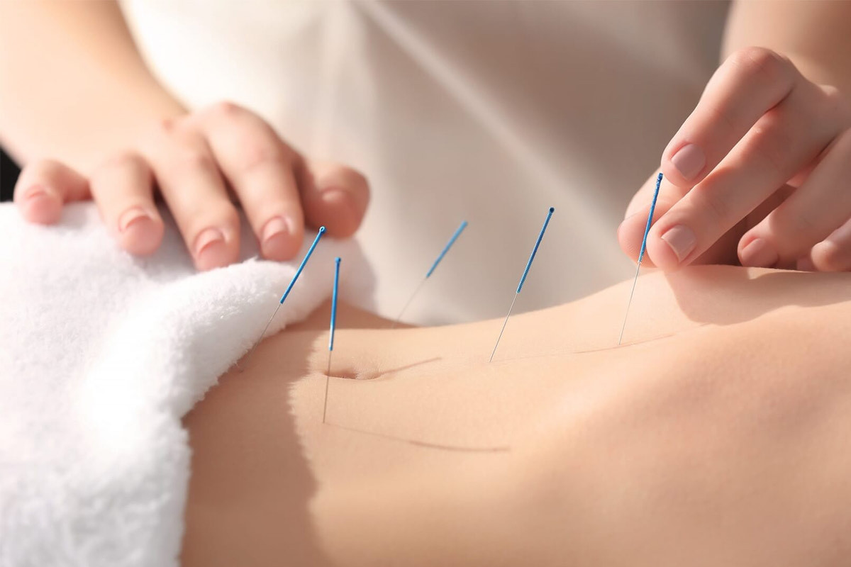 (P) Acupunctura – cât de eficientă este în rezolvarea problemelor de sănătate