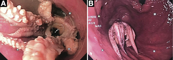 Descoperirea șocantă făcută de medici în esofagul unui pacient. Problemele bărbatului au apărut după ce a mâncat. FOTO