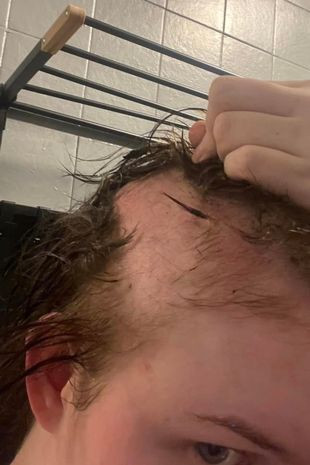 „Am fost devastată”. Ce a pățit o tânără la doar câteva săptămâni după ce și-a pus extensii de păr | FOTO