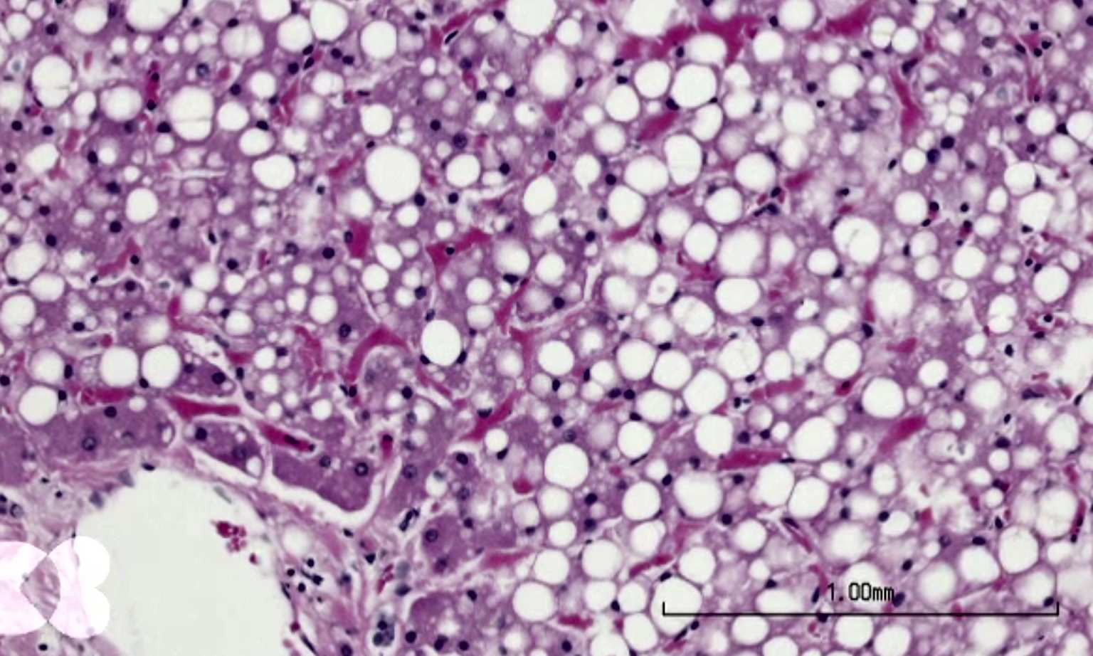 Ce spune un medic despre hepatoprotectoare la boala ficatului gras. Se tratează cauza