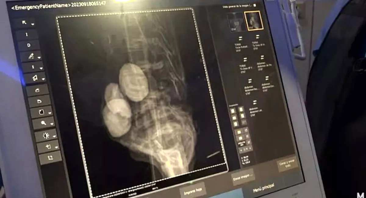 Unul din cadavrele de extratereștri prezentate Congresului din Mexic avea „ouă”. Descoperire șocantă a savanților, după CT