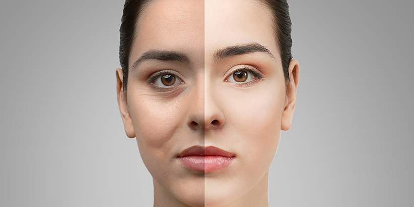 (P) Ce este blefaroplastia și de ce vedetele apelează la această intervenție