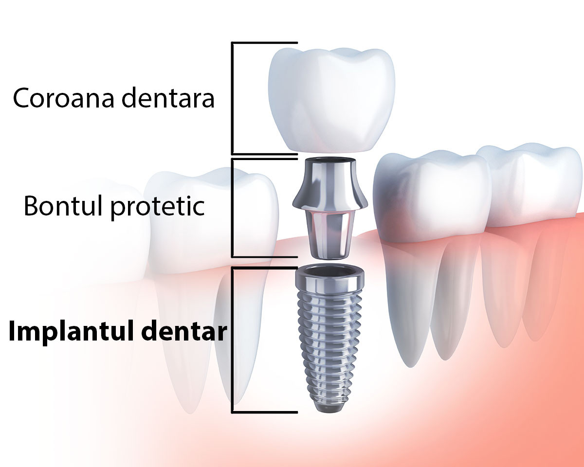 (P) Scurt ghid de inserare a unui implant dentar într-o clinică stomatologică