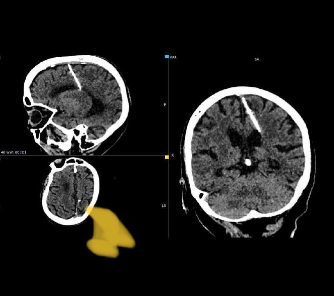 O femeie din Rusia a trăit timp de 80 de ani cu un ac înfipt în creier. Cum a fost posibil