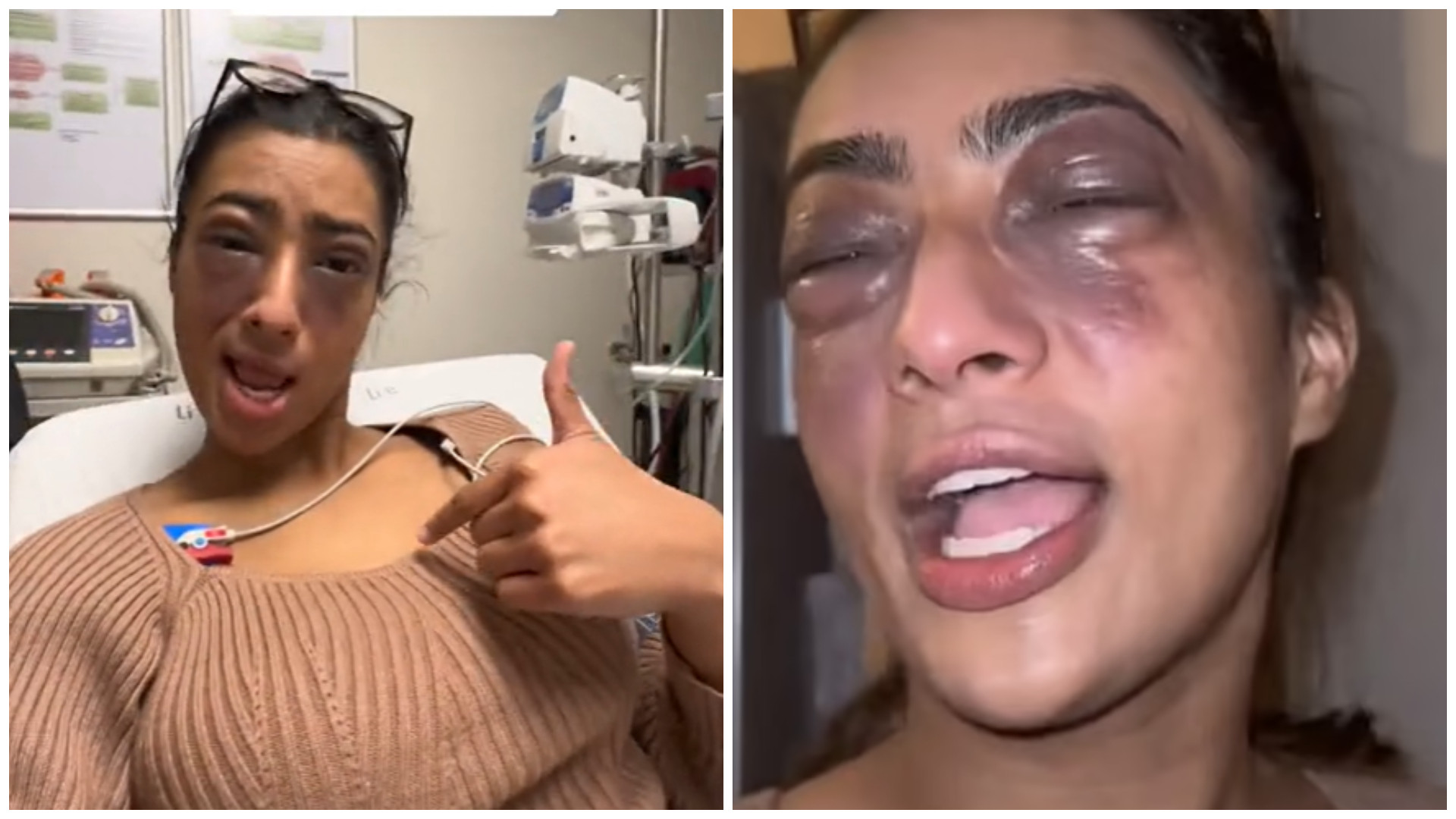 Ce a pățit o femeie după ce a atins un aliment care îi provoacă alergie. A fost la un pas de tragedie | VIDEO