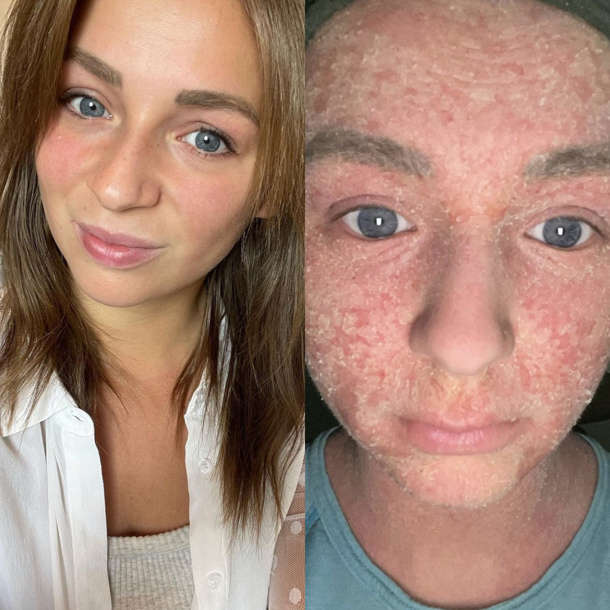 Experiența îngrozitoare a unei femei care a intrat în sevraj de steroizi. Cum a ajuns să arate după ce a renunțat la creme