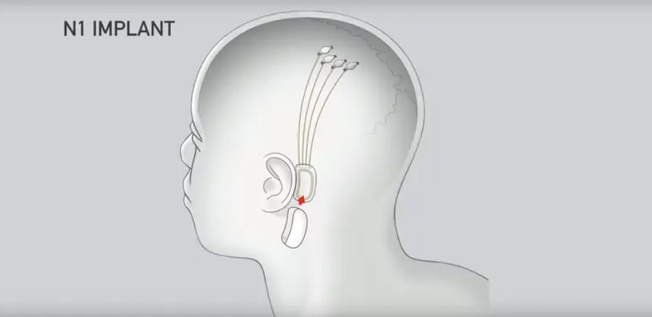Mii de oameni stau la coadă pentru a li se implanta cipuri în creier. Compania lui Elon Musk este gata să înceapă operațiile
