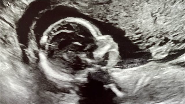 O femeie a ajuns subiect de studiu pentru medici. Are două utere în care poartă câte un copil