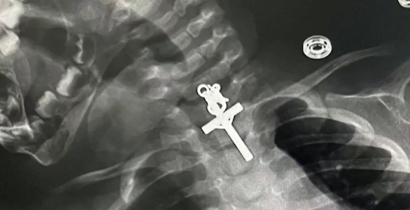 „Este un miracol”. Cum au reușit medicii să salveze o fetiță de zece luni, care a înghițit un crucifix. I s-a blocat în gât