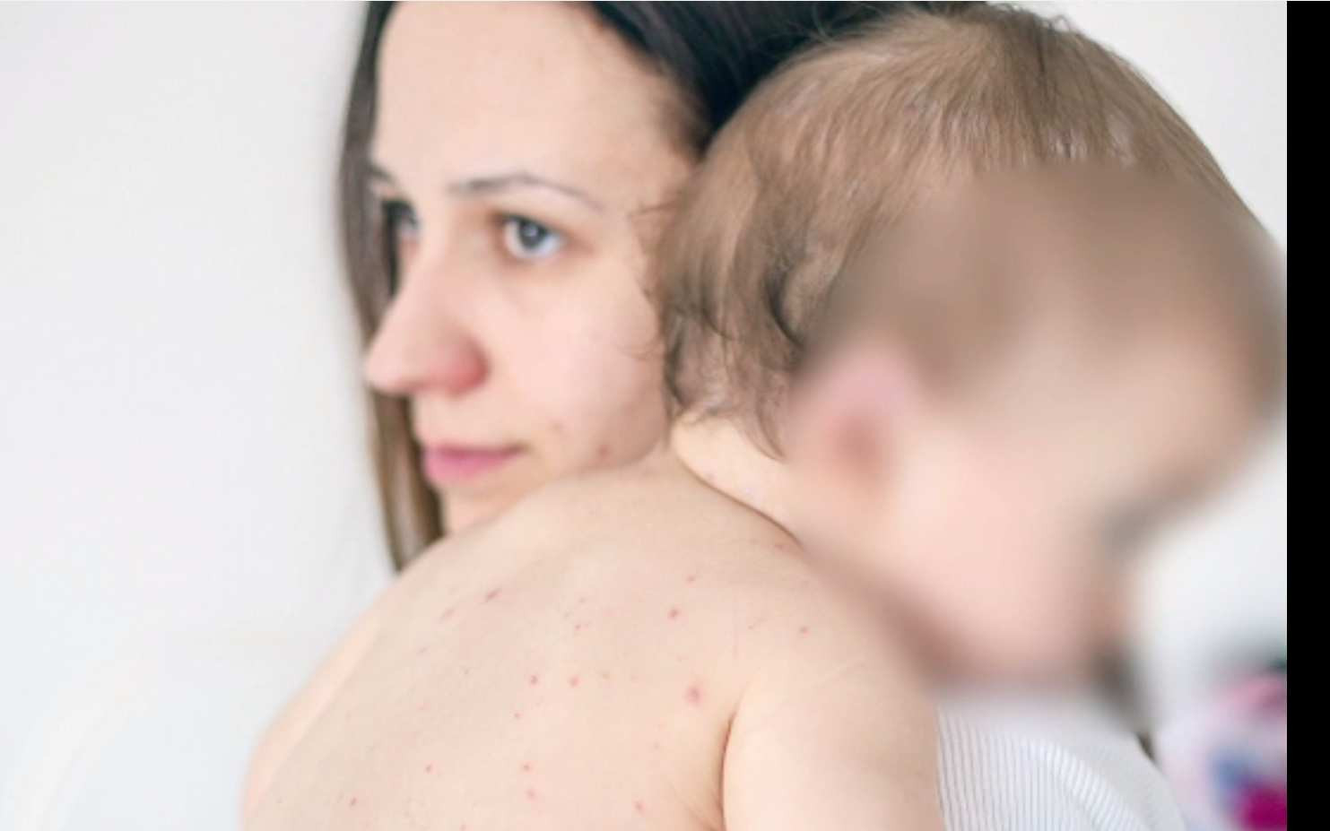 Câte cazuri de pojar au fost descoperite în București, numai la Institutul Matei Balș. S-a declarat epidemie de rujeolă