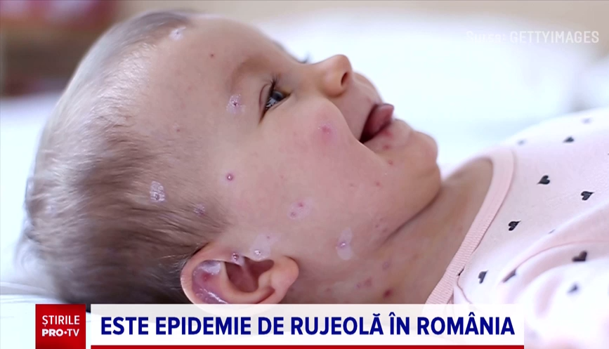 România, focar european de rujeolă: opt decese și 13.000 de cazuri într-un an. Rata vaccinării, 62%