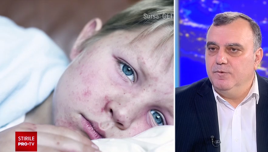 Alertă medicală. Focar de rujeolă într-o școală din București. Medic: ”Chiar acum avem copii cu insuficiență respiratorie”