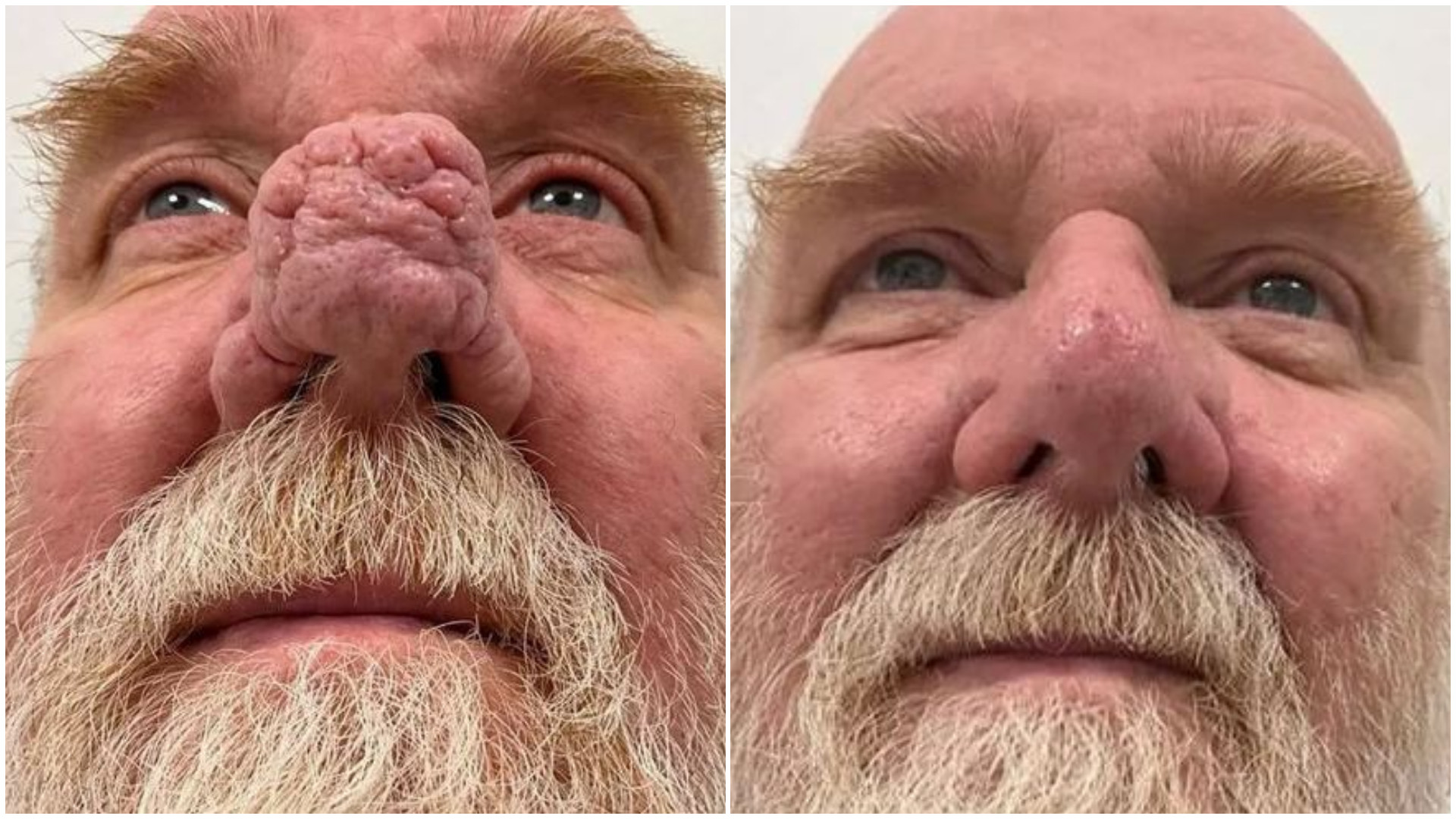 Cum arată „omul elefant”. Un bărbat cu o tumoare imensă și-a botezat nasul „John” | FOTO