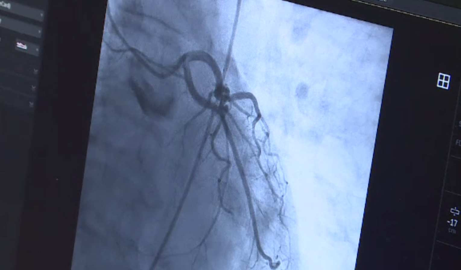 Intervenție complicată la Institutul CC Iliescu. Cateter și stent introdus prin vena femurală, inimă și artera pulmonară