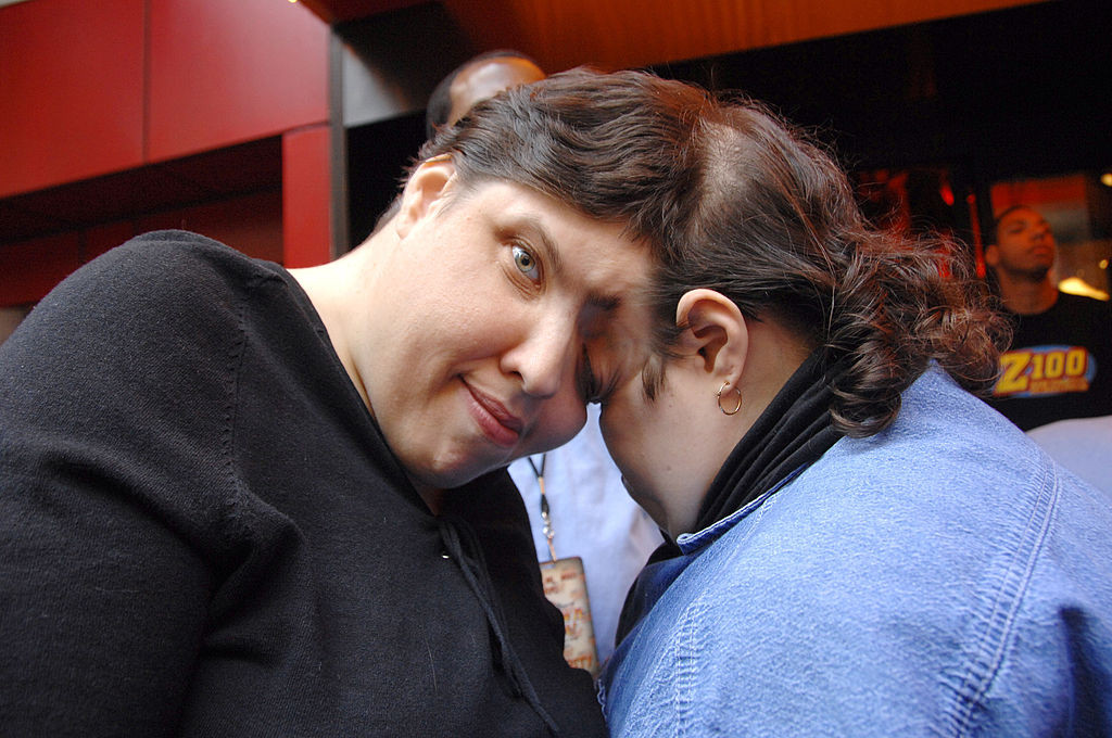 Cei mai bătrâni gemeni siamezi din lume au murit. Ce vârstă aveau | FOTO