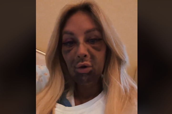 Pățania unei femei care a mers să-și pună implanturi dentare. A ajuns să arate ca „un monstru”. VIDEO